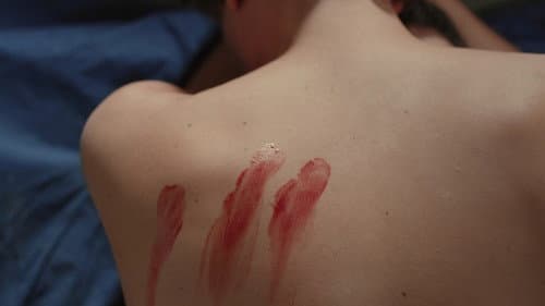 Wound
